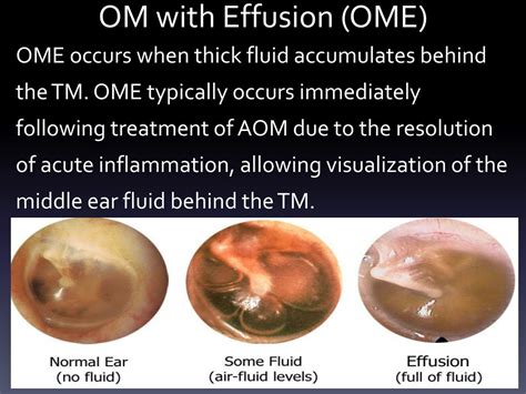 aom medical abbreviation.